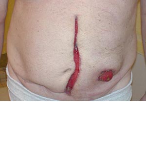 Incisions and Stoma